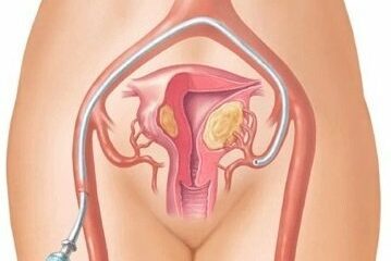 Embolizacion De Fibromas