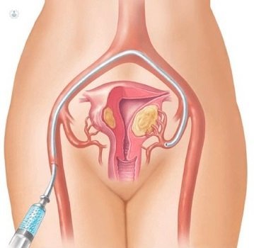 Embolizacion De Fibromas