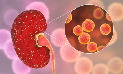 Que Es La Insuficiencia Renal Aguda Dialisis Peritoneal