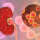 Que Es La Insuficiencia Renal Aguda Dialisis Peritoneal