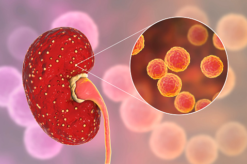 Que Es La Insuficiencia Renal Aguda Dialisis Peritoneal