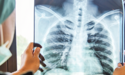 Tuberculosis 825x360 1