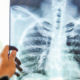 Tuberculosis 825x360 1