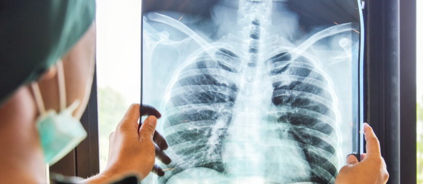Tuberculosis 825x360 1