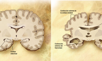 Cerebro Corte Frontal Alzheimer