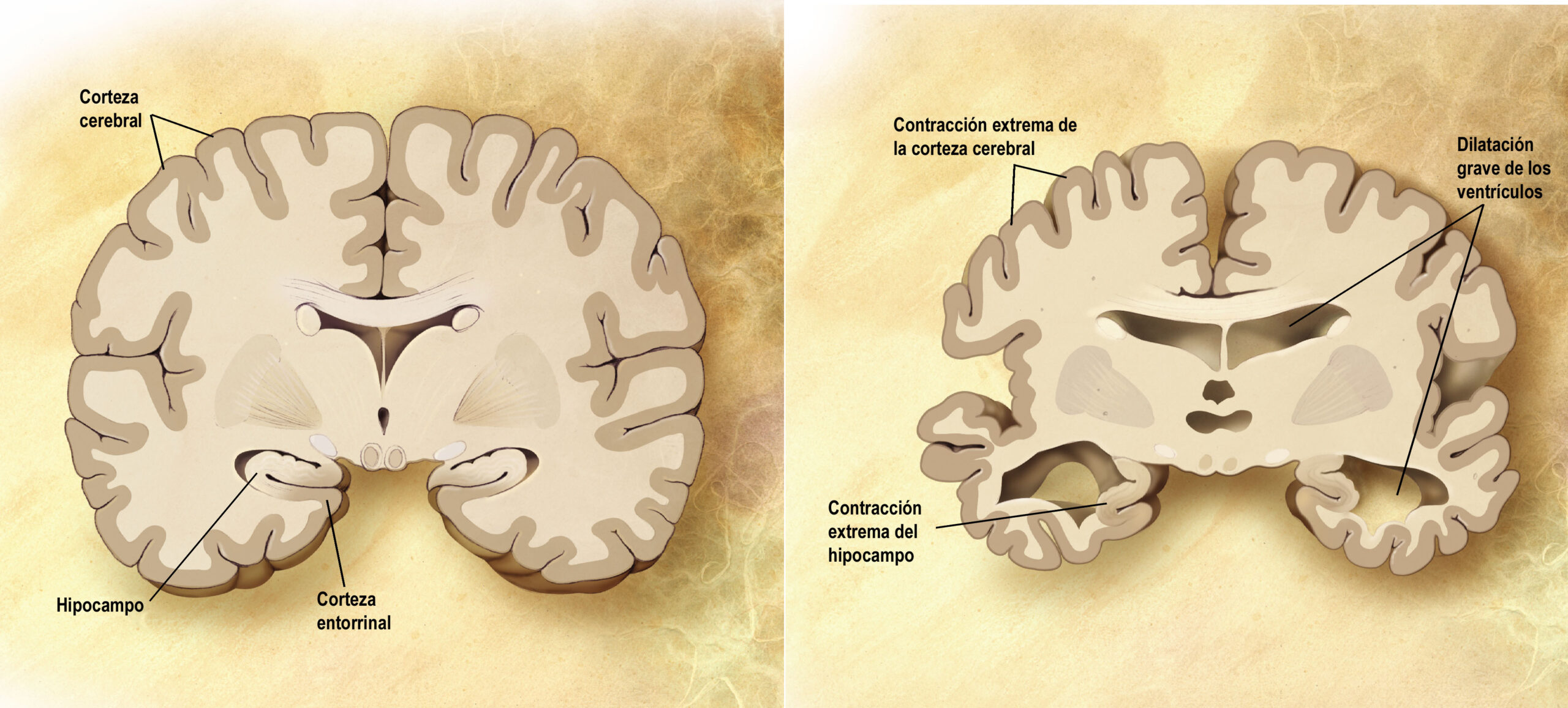 Cerebro Corte Frontal Alzheimer Scaled